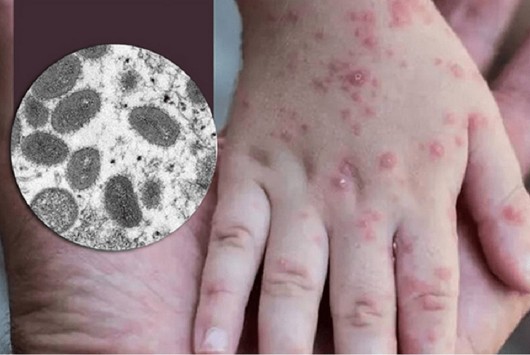 Hướng dẫn chẩn đoán, điều trị và phòng bệnh đậu mùa khỉ