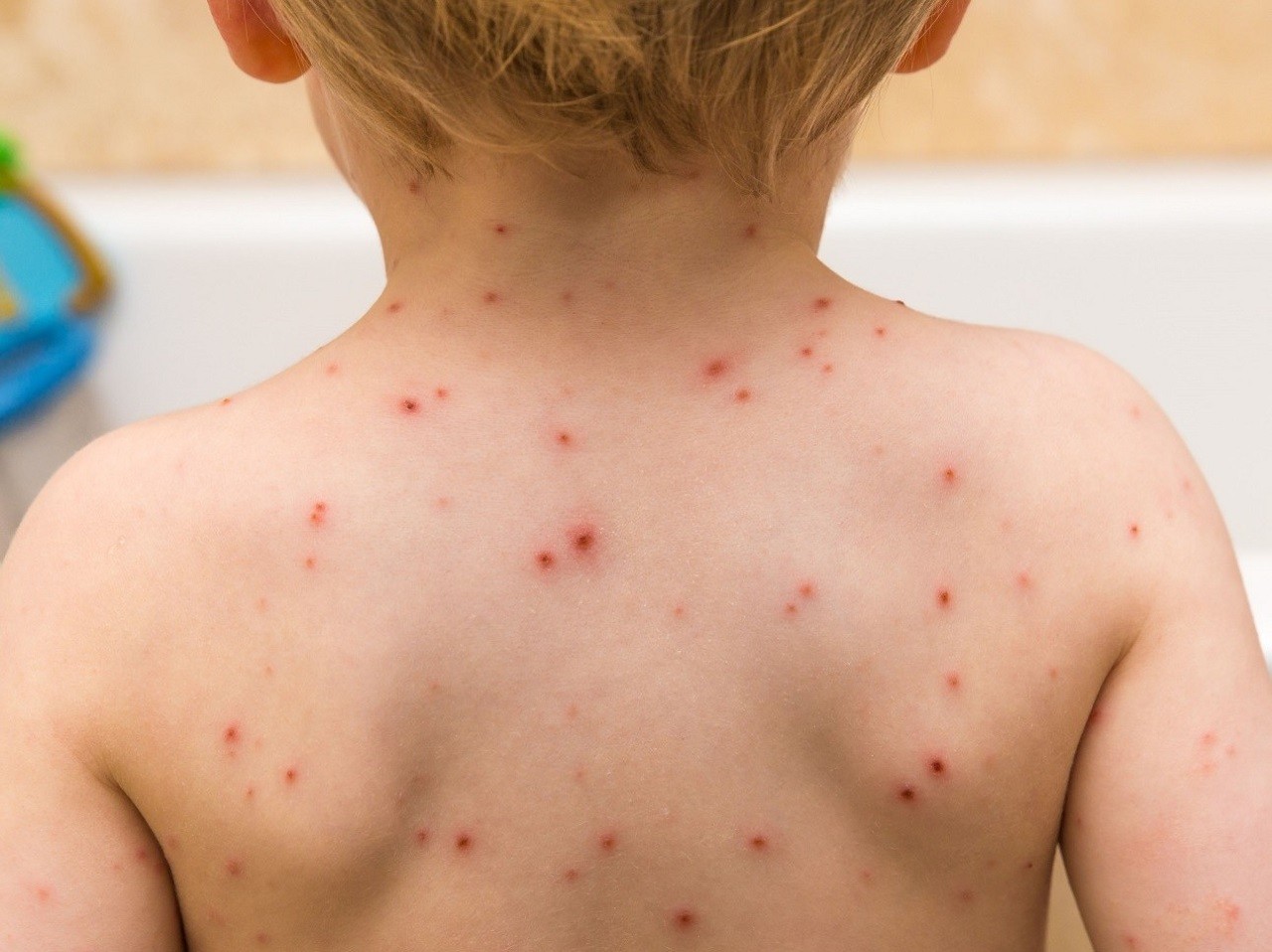 Sởi, thủy đậu - bệnh truyền nhiễm thường gặp ở trẻ em, cần làm gì để phòng bệnh?