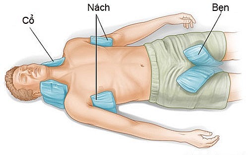 Áp túi nước đá vào nách, bẹn, cổ và lưng bệnh nhân vị sốc nhiệt để làm giảm nhiệt độ cơ thể