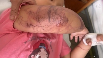 Bị sứa đốt khi tắm biển, bé gái 7 tuổi nhập viện cấp cứu trong tình trạng mất ý thức