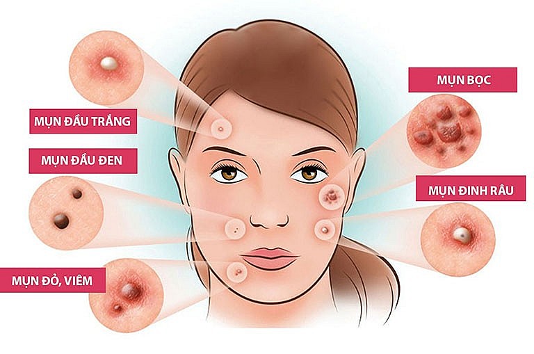 Làm giảm và ngăn ngừa mụn cho da mặt với những mẹo cực đơn giản sau đây