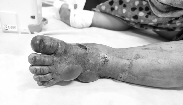 Bàn chân bệnh nhi tím đen sau khi bị rắn hổ mang cắn - Ảnh: Bệnh viện cung cấp