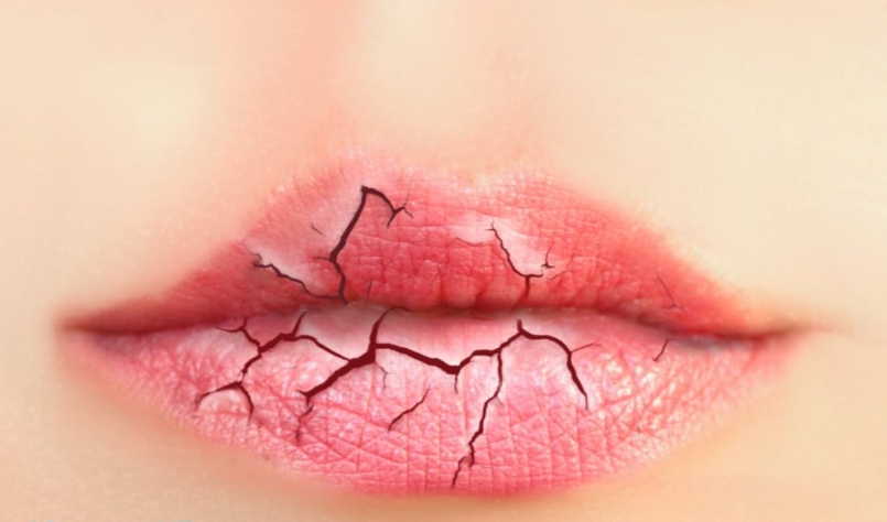 Khô môi, nứt môi gây chảy máu là nỗi ám ảnh của tất cả mọi người