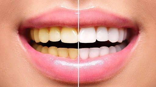 Tẩy trắng răng không đúng cách sẽ để lại tác hại khôn lường