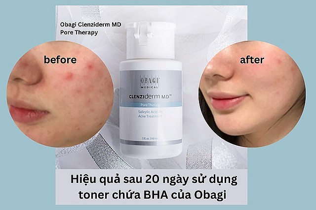 Review top 5 BHA đang được các tín đồ skincare tin dùng