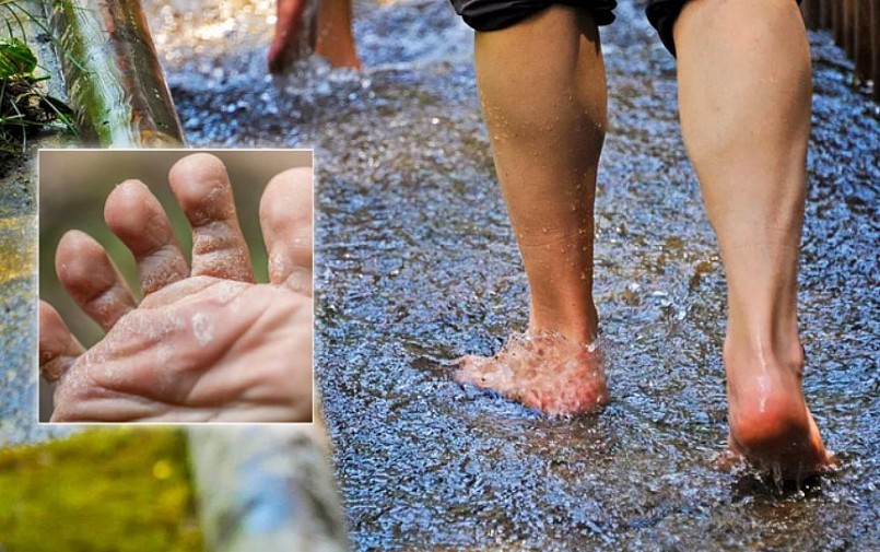Những cách chữa nước ăn chân mùa mưa tại nhà hiệu quả
