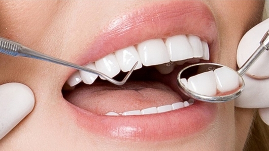 Những điều bạn cần biết trước khi làm răng sứ