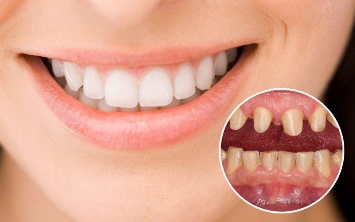 Khi mang răng sứ có thể xảy những vấn đề khi mang răng sứ