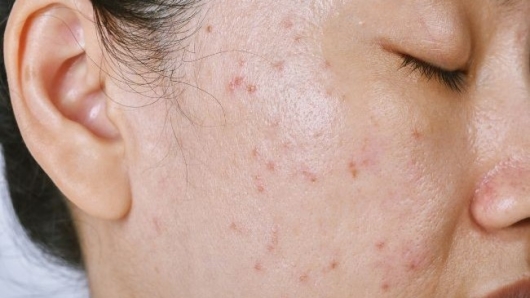 Làm giảm và ngăn ngừa mụn cho da mặt với những mẹo cực đơn giản sau đây