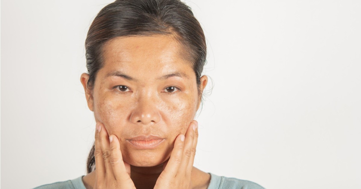 Các thực phẩm “vàng” trong làng trị nám