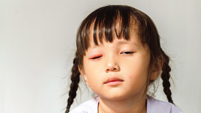 Bộ Y tế khuyến cáo 5 biện pháp phòng chống bệnh đau mắt đỏ