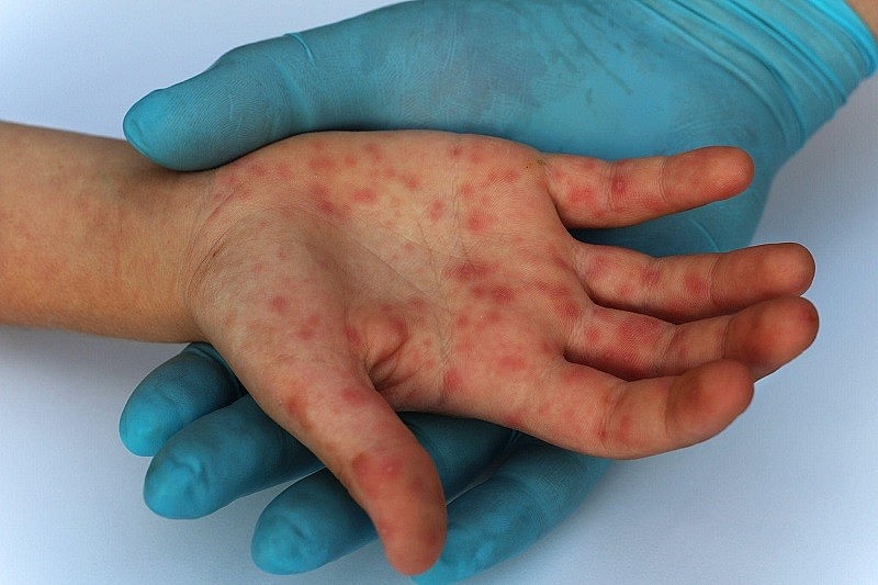 Bệnh nhân ở Đồng Nai là ca bệnh mắc đậu mùa khỉ thứ 3 tại Việt Nam 