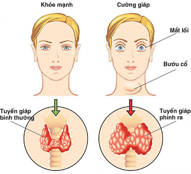 Những thực phẩm người bị bướu cổ nên bổ sung