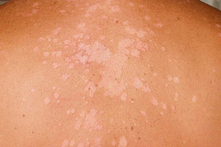 Làm gì để phòng các bệnh về da trong mùa nắng nóng?