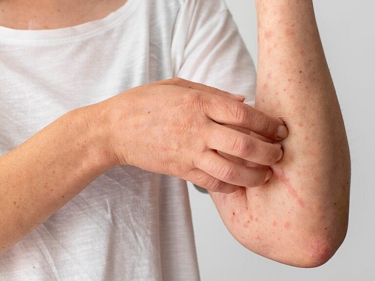 Làm gì để phòng các bệnh về da trong mùa nắng nóng?