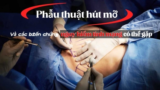 Phẫu thuật hút mỡ và các biến chứng nguy hiểm tính mạng có thể gặp