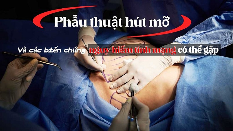 Phẫu thuật hút mỡ và các biến chứng nguy hiểm tính mạng có thể gặp