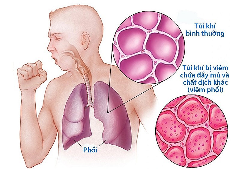 Những cách đơn giản bảo vệ phổi mùa lạnh