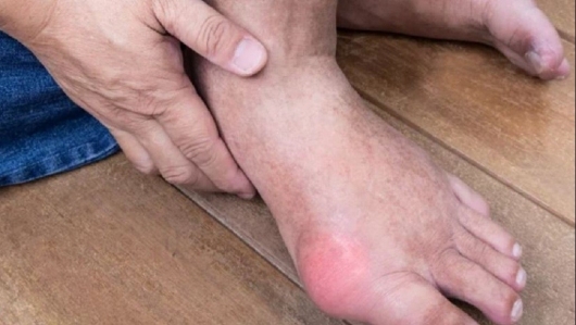 Người bệnh gout nên tránh ăn gì trong dịp Tết?