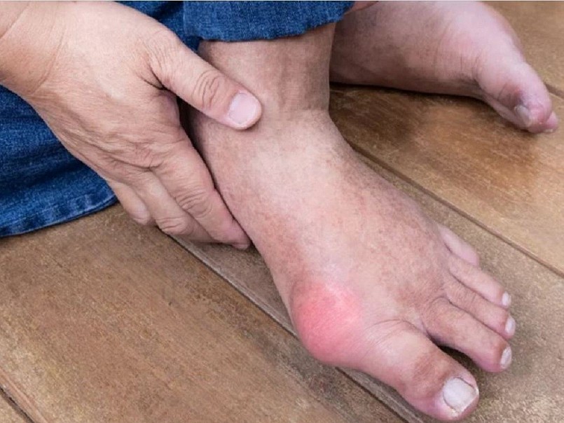 Người bệnh gout nên tránh ăn gì trong dịp Tết?