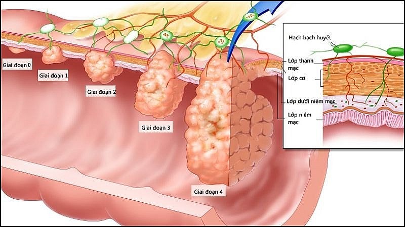 Người mẫu 30 tuổi qua đời vì ung thư trực tràng, căn bệnh này nguy hiểm thế nào?