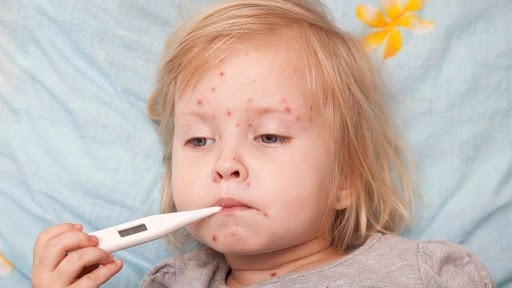 Số ca sởi tăng nhanh, cần chủ động phòng ngừa sởi bằng vaccine