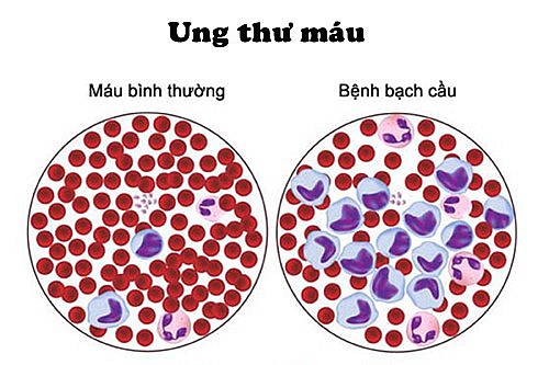 Từ câu chuyện của bé Bắp: Tìm hiểu về bệnh ung thư máu ở trẻ em