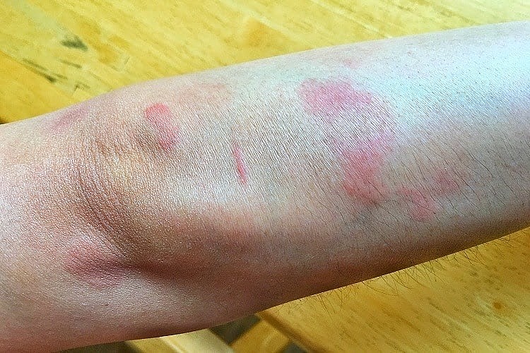lupus ban đỏ. (Ảnh minh họa)