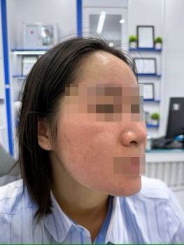 Trị mụn bằng chanh: Hậu quả đáng sợ sau khi thử 