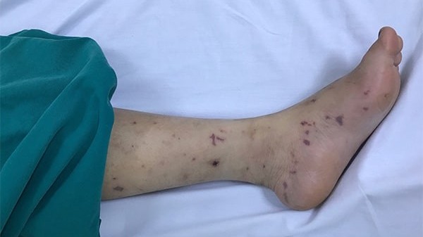 Bệnh não mô cầu gia tăng ở miền Nam