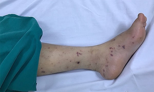 Bệnh não mô cầu gia tăng ở miền Nam