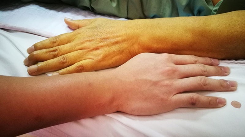 Dấu hiệu của gan bị tổn thương