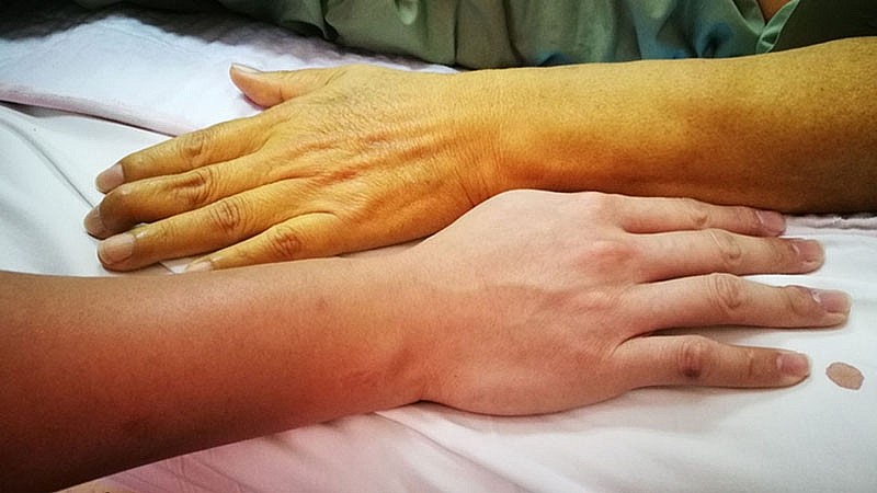 Một trong những dấu hiệu rõ ràng nhất của tổn thương gan là hiện tượng vàng da và vàng mắt.