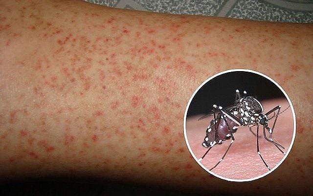 Việc theo dõi sát các biểu hiện lâm sàng sẽ giúp phát hiện sớm diễn biến nặng và xử lý kịp thời.