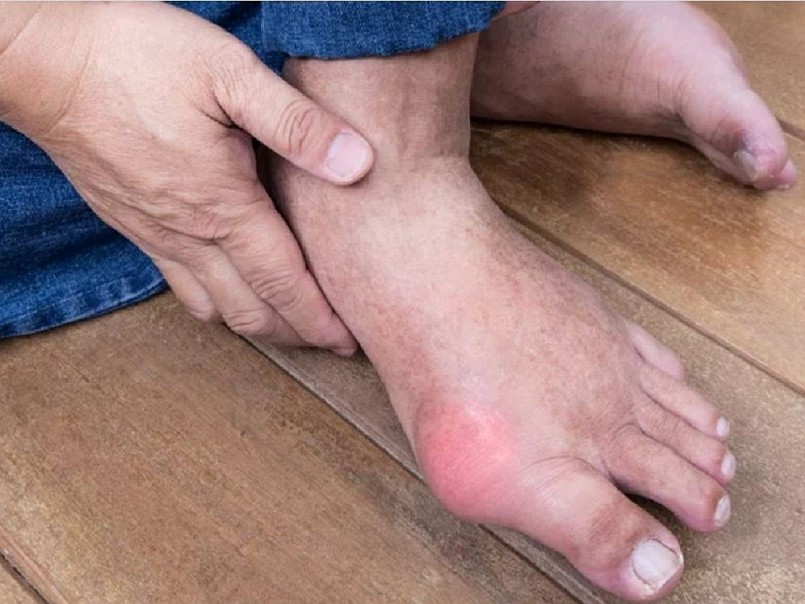 Gút là một dạng viêm khớp phổ biến, hình thành khi nồng độ axit uric trong máu tăng cao.