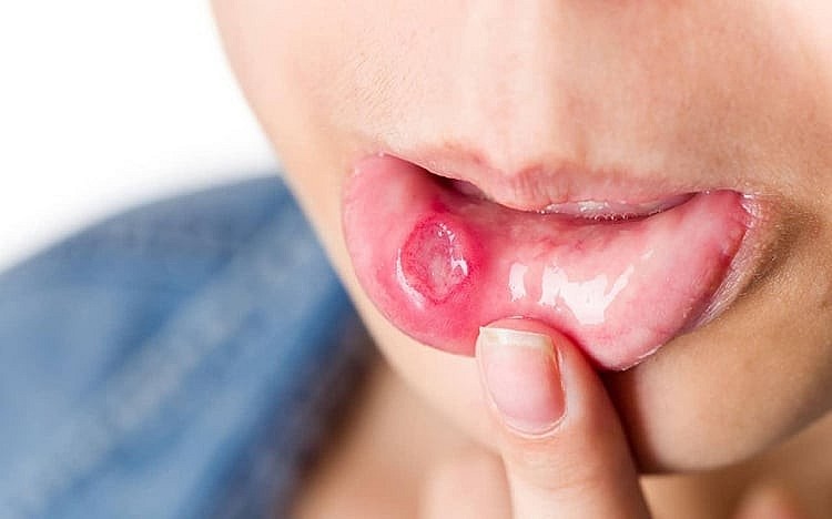 Nhiệt miệng uống gì cho nhanh khỏi?