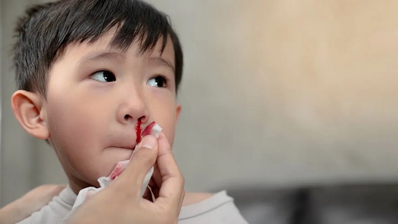 Chảy máu cam: Làm sao để xử lý nhanh và đúng cách tại nhà?