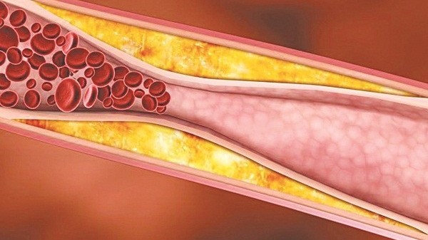 Bác sĩ lý giải vì sao người gầy vẫn mắc mỡ máu cao