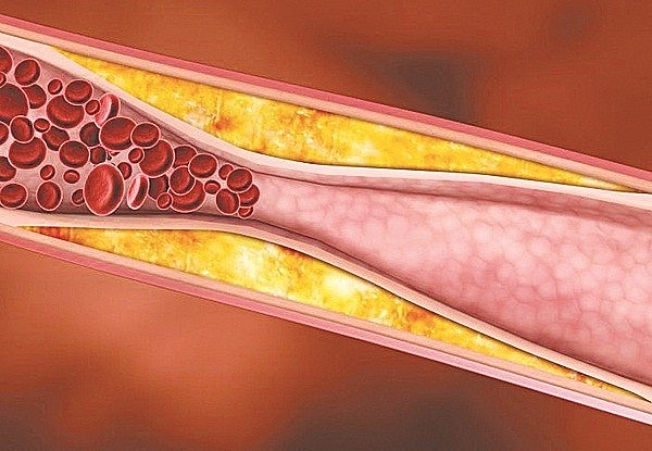 Rối loạn mỡ máu (hay còn gọi là rối loạn lipid máu, mỡ máu cao) là tình trạng tăng hoặc giảm bất thường các chỉ số lipid trong máu.