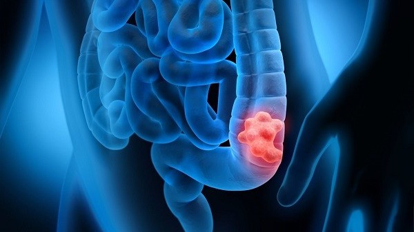 Những thói quen đơn giản giúp phòng ung thư đại trực tràng hiệu quả