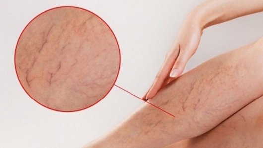 Hiểu rõ về căn bệnh suy giảm tĩnh mạch
