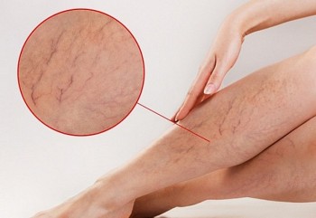 Hiểu rõ về căn bệnh suy giảm tĩnh mạch