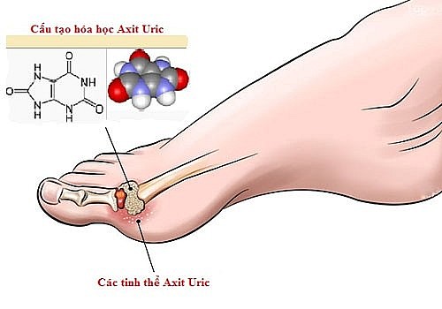 Axit uric cao: “Kẻ thù giấu mặt” của sức khỏe
