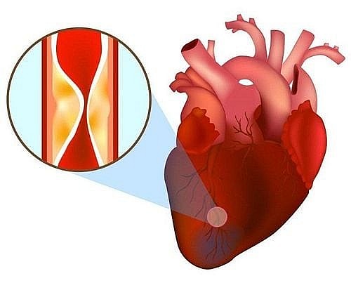 Tại Việt Nam, theo thống kê của Bộ Y tế, có hơn 200.000 người tử vong do bệnh tim mạch trong năm 2023, chiếm 33% tổng số ca tử vong. 