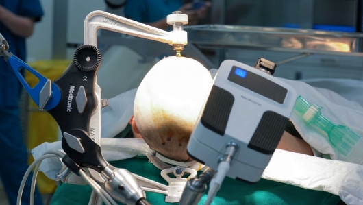 Vinmec tiên phong điều trị động kinh bằng Robot định vị thần kinh hàng đầu thế giới