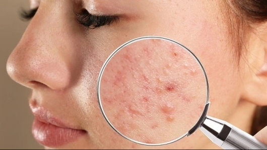 Trị mụn: Cẩn thận kẻo “tiền mất, sẹo mang”