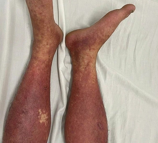 Hình ảnh phát ban toàn thân trên bệnh nhân dị ứng thuốc nặng do Phenylbutazone đang được điều trị tại Trung tâm Dị ứng & Miễn dịch lâm sàng. Ảnh Bệnh viện Bạch Mai.