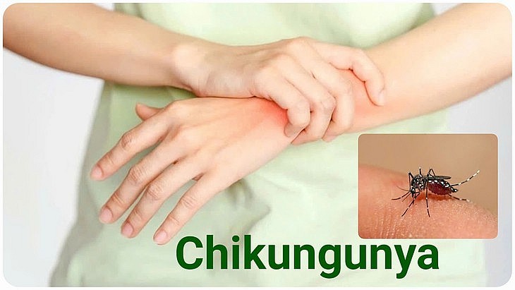 Muỗi vằn Aedes là trung gian truyền bệnh Chikungunya sang người