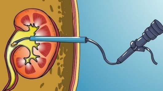 Chế độ chăm sóc và dinh dưỡng chuẩn sau tán sỏi thận