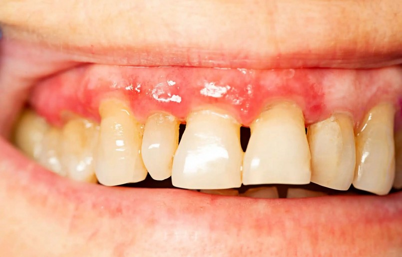 Nỗi sợ hãi khi đến phòng nha là một rào cản tâm lý phổ biến không chỉ ở Việt Nam mà trên toàn thế giới. 